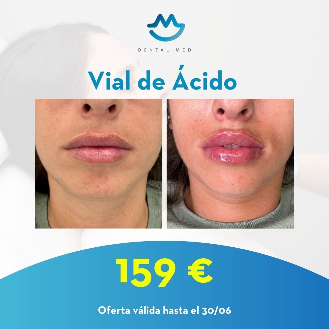 Dental-Med-Clínica-Debtal-Sevilla-Promoción-en-Aplicación-ácido-hialurrónico