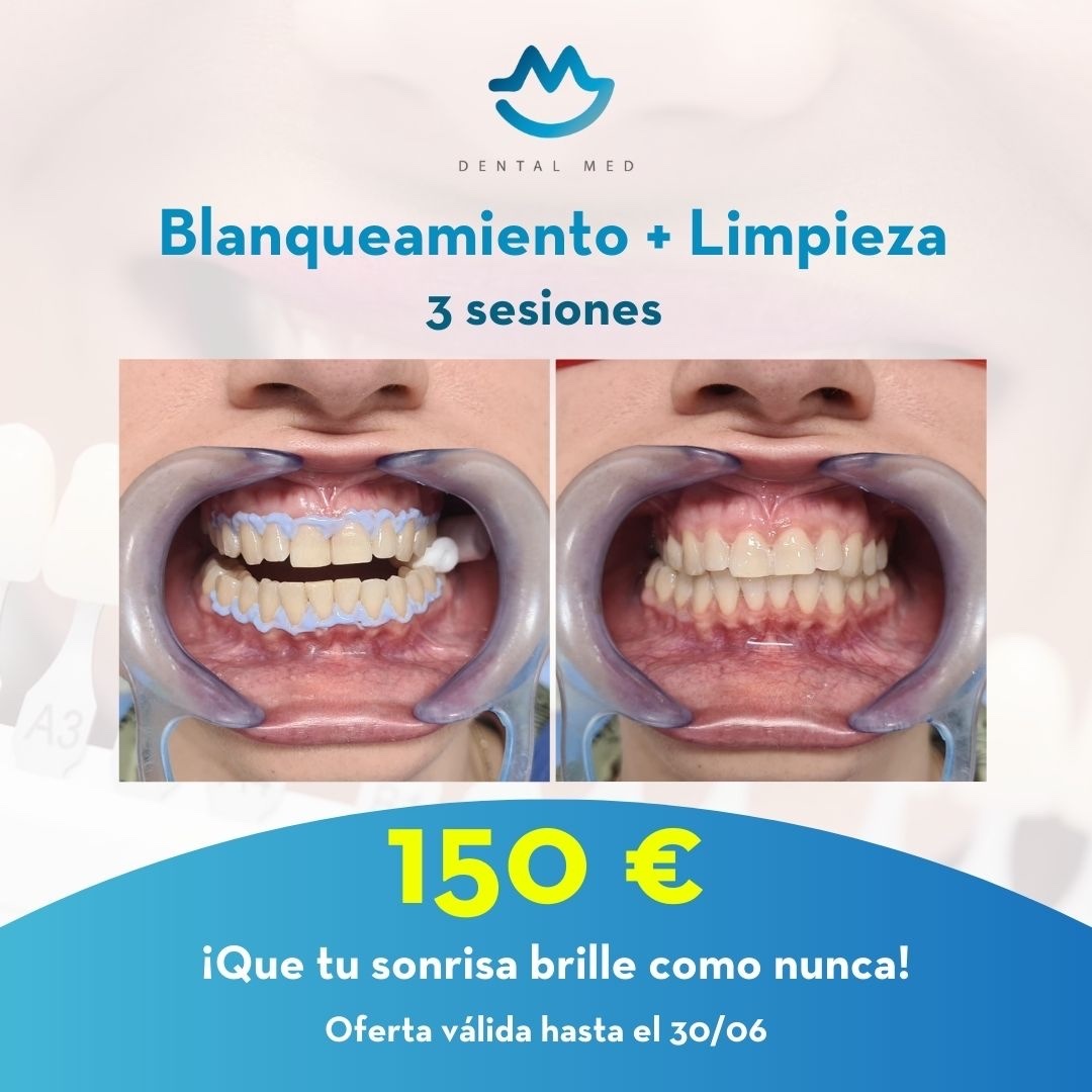 Dental-Med-Clínica-Debtal-Sevilla-Promoción-en-limpieza-dental-blanqueamiento-y-limpieza-dental