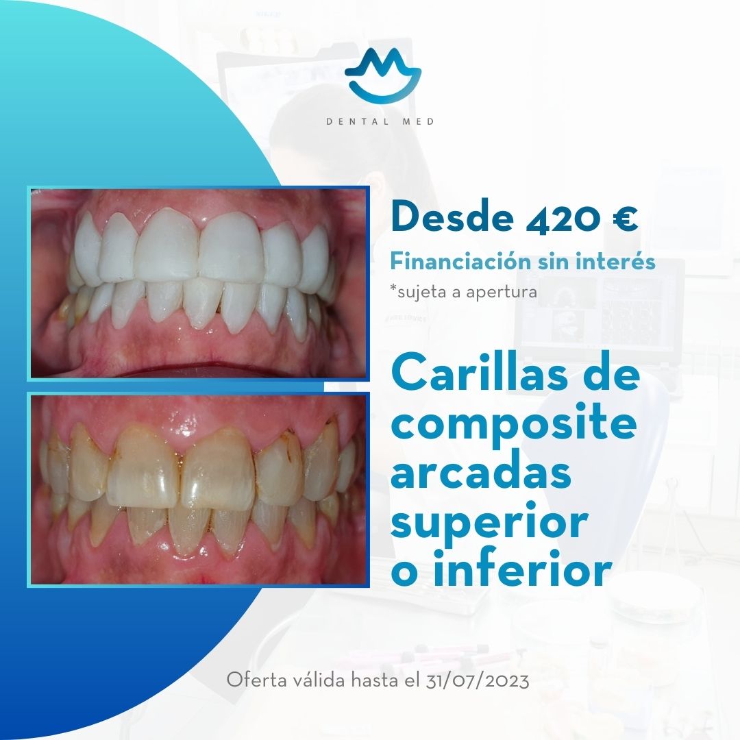 Dental Med, Clínica Dental - Carillas de Composite Superior o Inferior - Odontología Sevilla - Ortodoncia - Oferta Carillas de Composite Sevilla