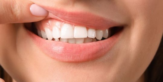 Tratamiento dental con ácido hialurónico - Sonrisa gingival