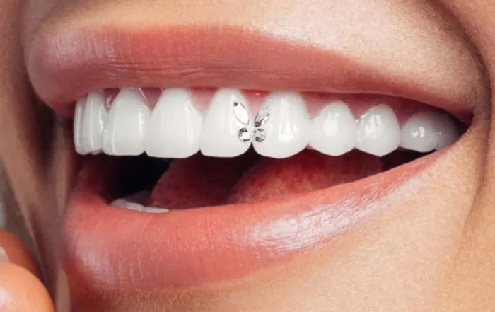 Dental Med Sevilla, Dentistas en Sevilla, Gemas dentales
